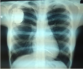 Patient's chest x-ray